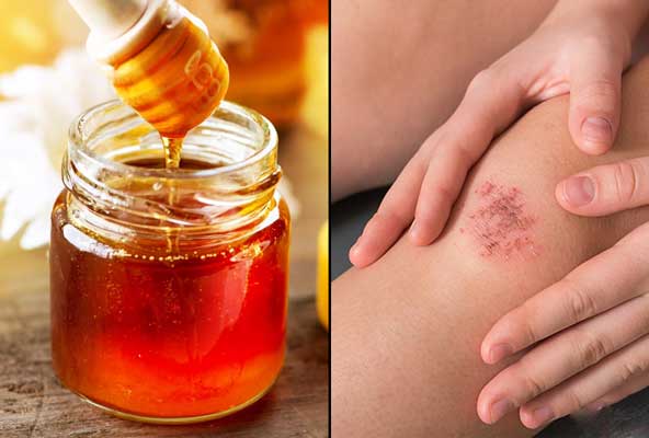 خواص عسل طبیعی و درمان زخم